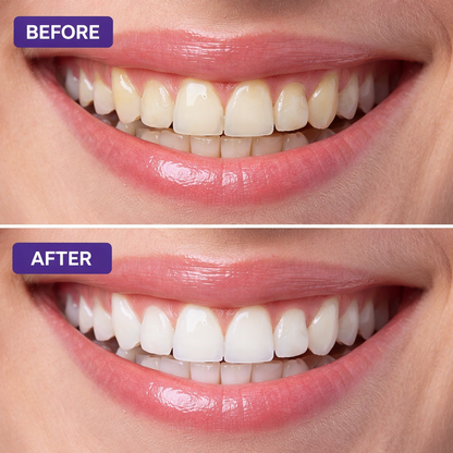 PearlBright Teeth Whitening Strips